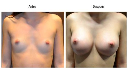 Descubre el mejor antes y después de aumento de pecho en Andorra de Clínicas Dorsia.
