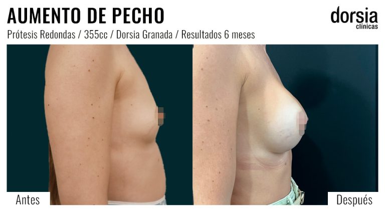 Fotos de aumento de pecho redondas: antes y después. Cirugía mamaria en Granada