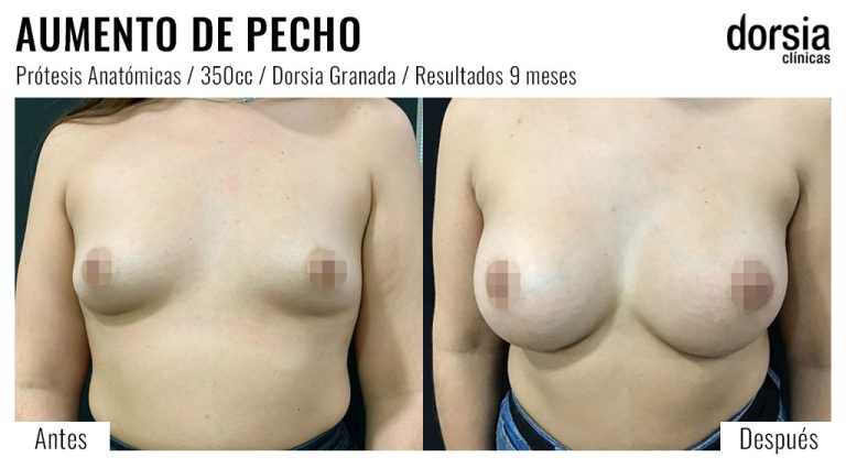 Fotos de aumento de pecho anatomicas: antes y después. Cirugía mamaria en Granada