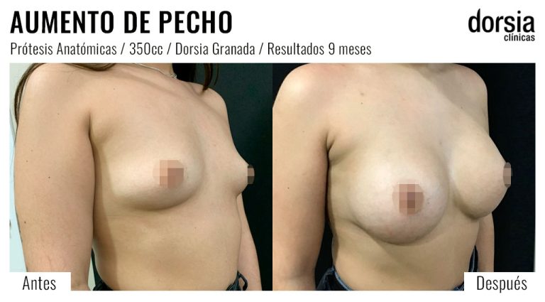 Fotos de aumento de pecho anatomicas: antes y después. Cirugía mamaria en Granada