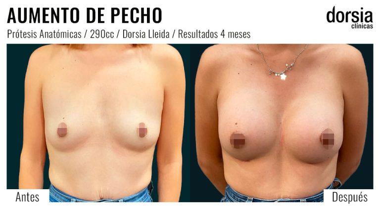 Fotos de aumento de pecho anatomicas: antes y después. Cirugía mamaria en Lleida