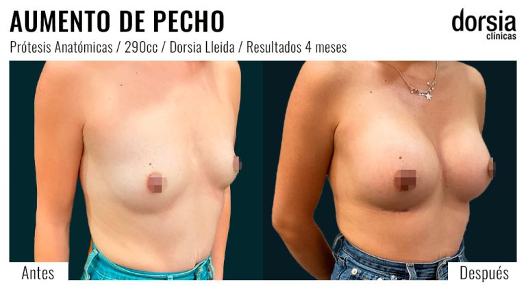 Fotos de aumento de pecho anatomicas: antes y después. Cirugía mamaria en Lleida