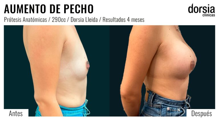 Fotos de aumento de pecho anatomicas: antes y después. Cirugía mamaria en Lleida