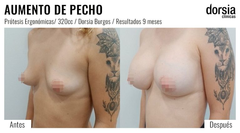 Fotos de aumento de pecho ergonomicas: antes y después. Cirugía mamaria en Burgos