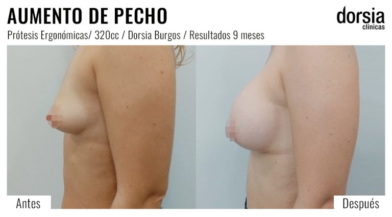 Fotos de aumento de pecho ergonomicas: antes y después. Cirugía mamaria en Burgos