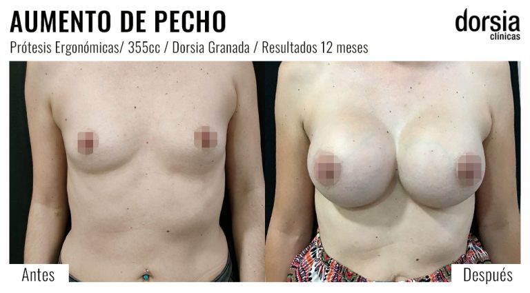 Fotos de aumento de pecho ergonomicas: antes y después. Cirugía mamaria en Granada