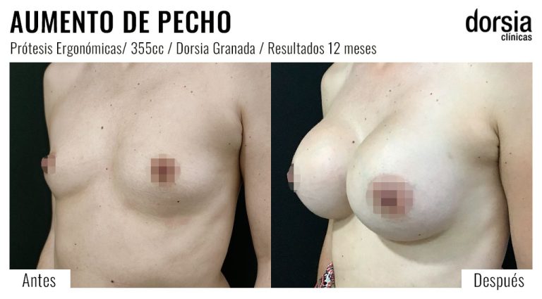 Fotos de aumento de pecho ergonomicas: antes y después. Cirugía mamaria en Granada