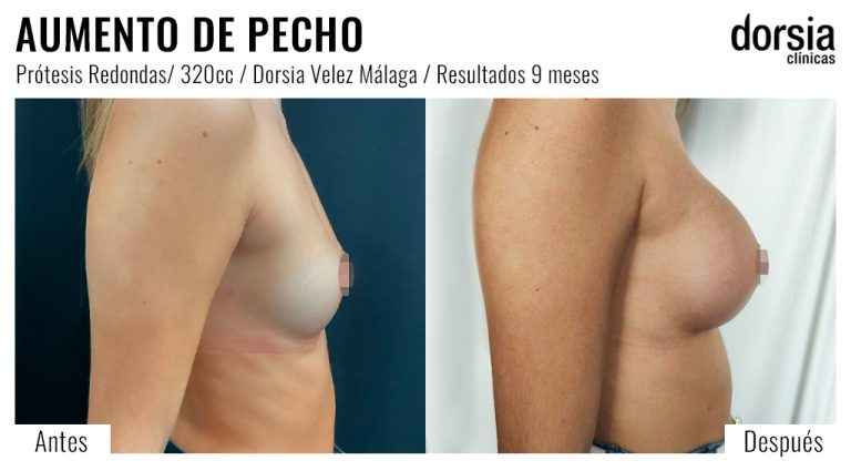Fotos de aumento de pecho prótesis redondas. Antes y después. Cirugía mamaria en Malaga