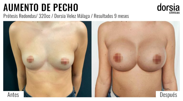 Fotos de aumento de pecho prótesis redondas. Antes y después. Cirugía mamaria en Malaga