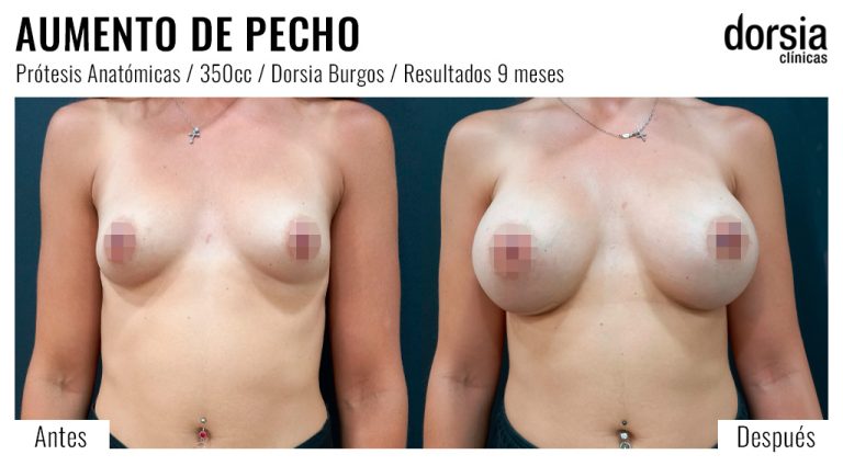 Fotos de aumento de pecho prótesis anatomicas. Antes y después. Cirugía mamaria en Burgos