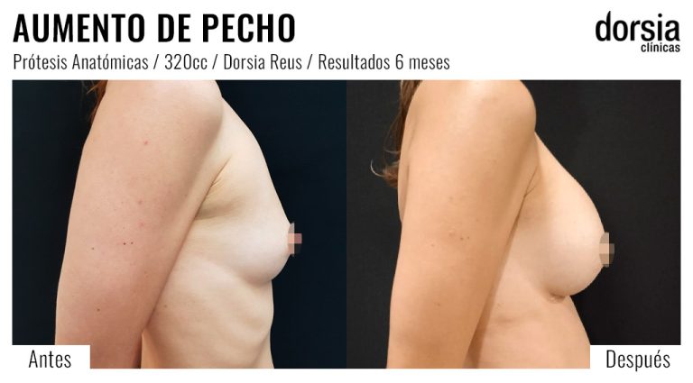 Fotos de aumento de pecho prótesis anatomicas. Antes y después. Cirugía mamaria en Reus
