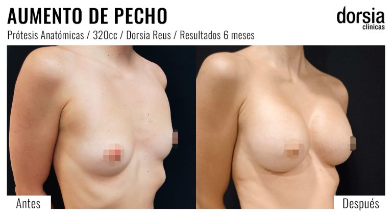 Fotos de aumento de pecho prótesis anatomicas. Antes y después. Cirugía mamaria en Reus