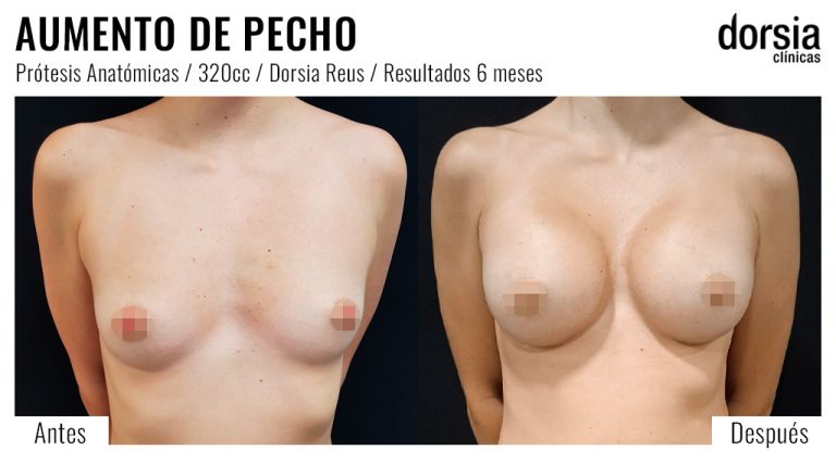 Fotos de aumento de pecho prótesis anatomicas. Antes y después. Cirugía mamaria en Reus