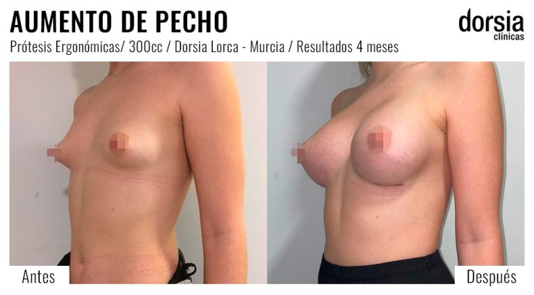 Fotos de aumento de pecho prótesis ergonomicas. Antes y después. Cirugía mamaria en Lorca