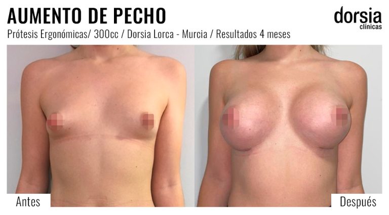 Fotos de aumento de pecho prótesis ergonomicas. Antes y después. Cirugía mamaria en Lorca