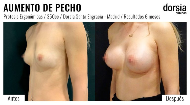 Fotos de aumento de pecho prótesis ergonomicas. Antes y después. Cirugía mamaria en Madrid