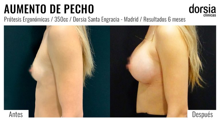 Fotos de aumento de pecho prótesis ergonomicas. Antes y después. Cirugía mamaria en Madrid