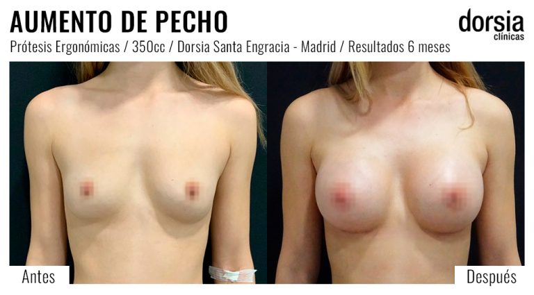 Fotos de aumento de pecho prótesis ergonomicas. Antes y después. Cirugía mamaria en Madrid
