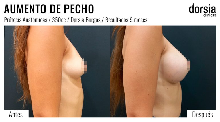 Fotos de aumento de pecho prótesis anatomicas. Antes y después. Cirugía mamaria en Burgos
