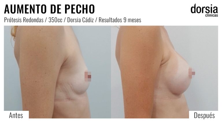 Fotos de aumento de pecho prótesis redondas. Antes y después. Cirugía mamaria en Cadiz