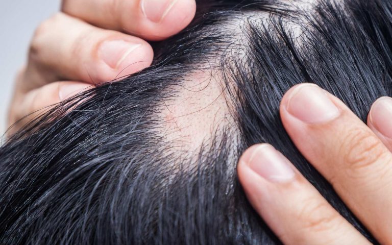 tratamiento con Dutasteride para la alopecia