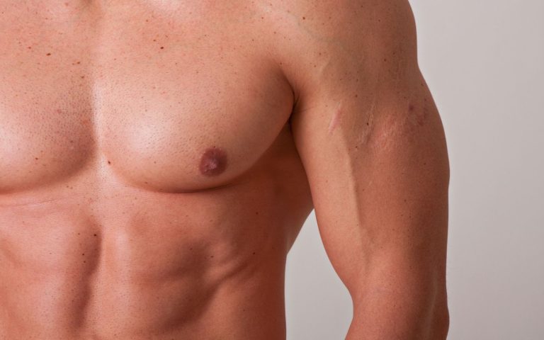 causas galactorrea hombre
