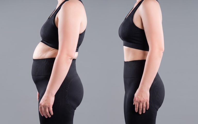 perdida de kilos en liposuccion