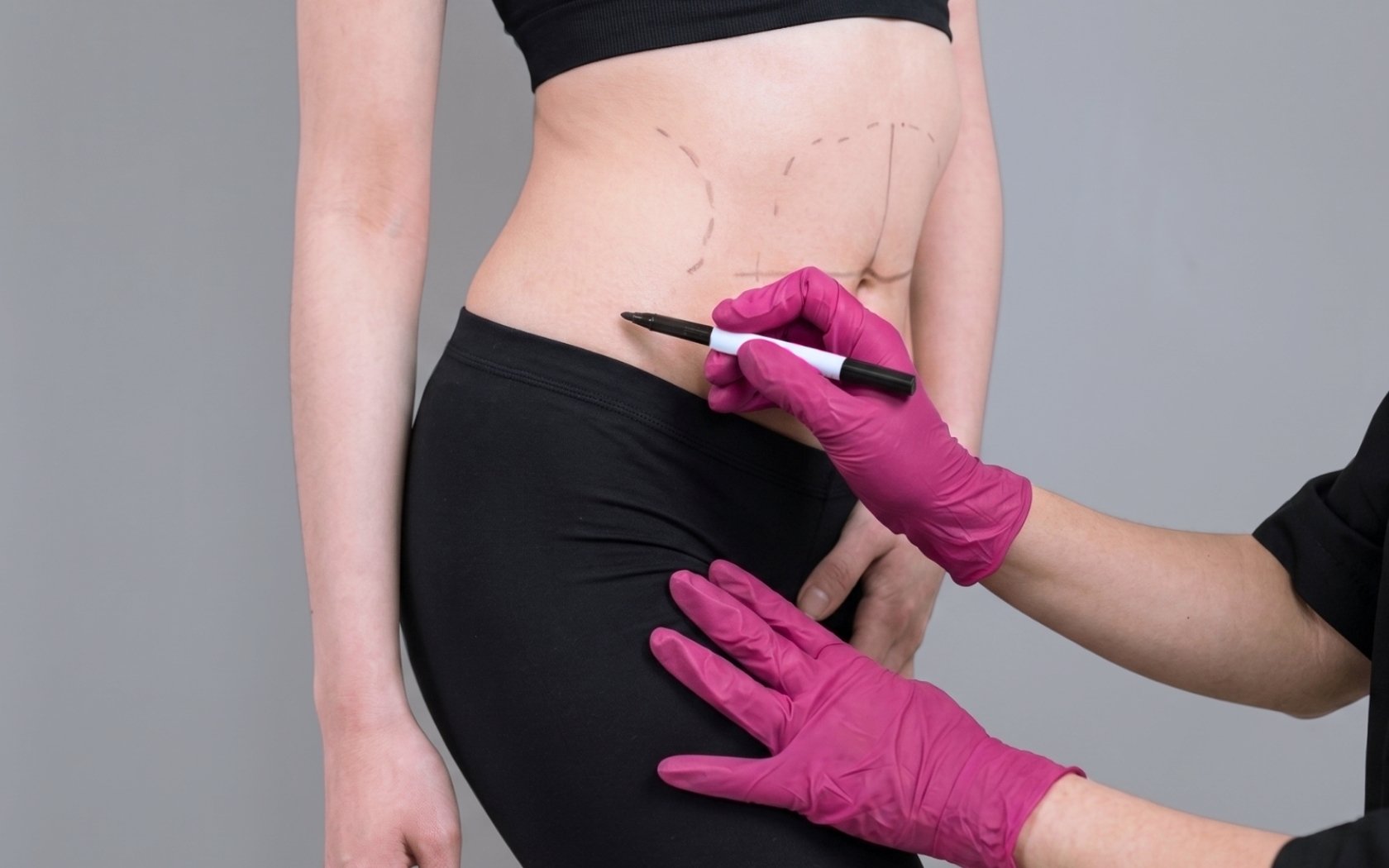 Me hice una liposucción y no veo resultados | Dorsia