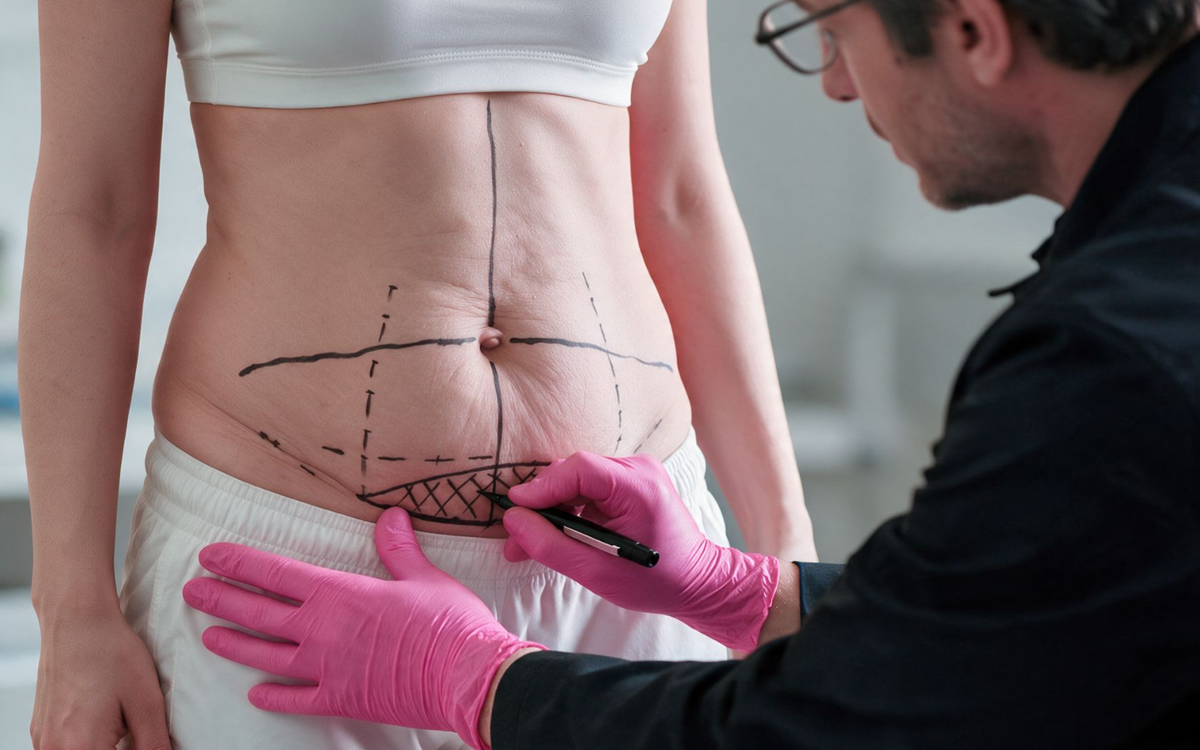 Miniabdominoplastia vs abdominoplastia completa | Dorsia