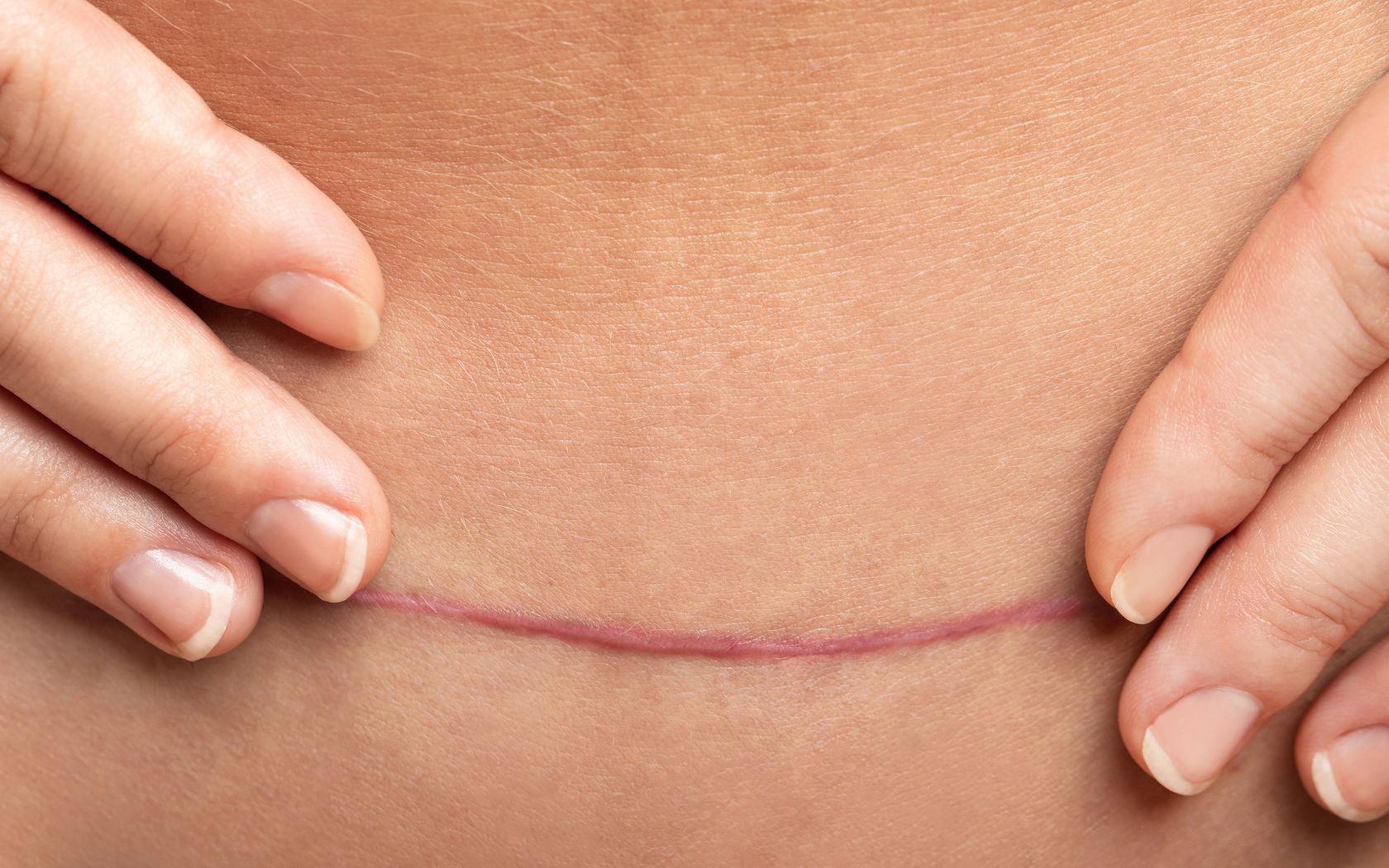 ¿Se pueden eliminar cicatrices quirúrgicas? Respuesta experta | Dorsia