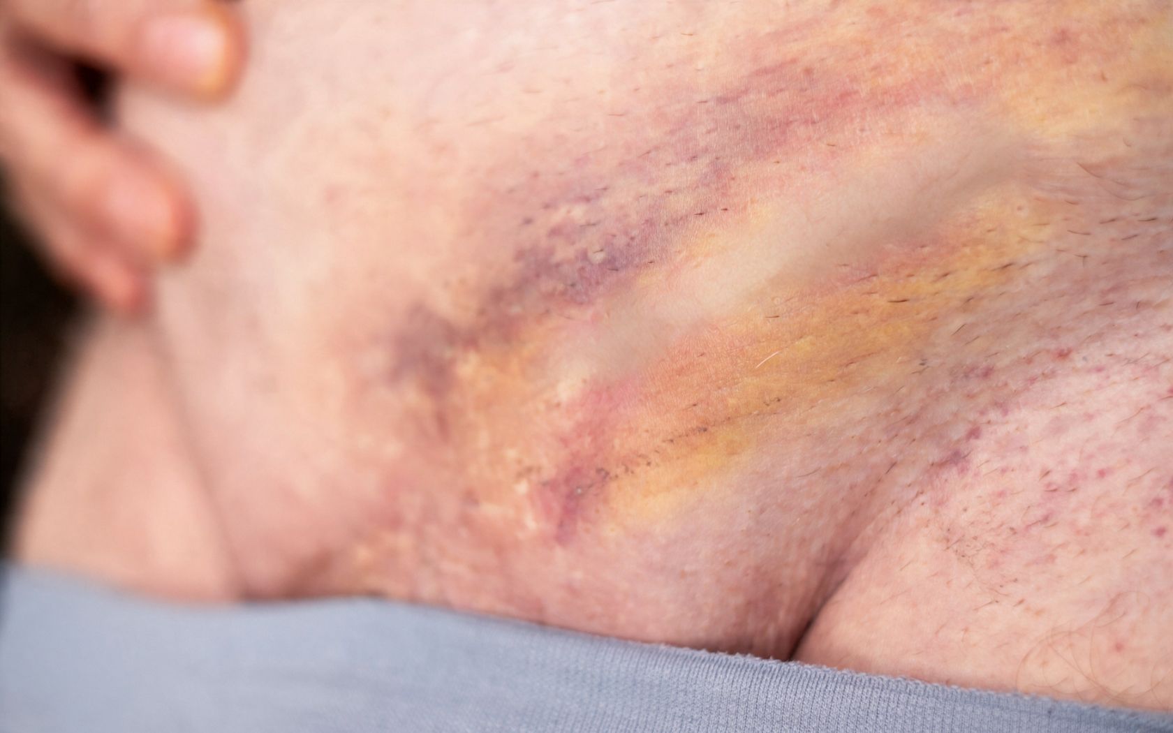 Descubre cuánto dura la equimosis tras cirugía | Dorsia