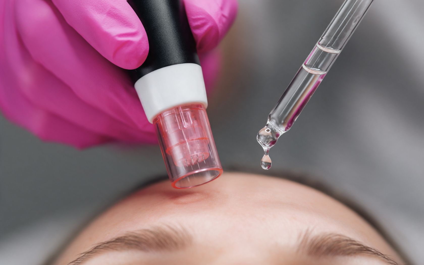 Microneedling con exosomas para mejorar la piel: qué es